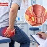 Ilustrasi abses anus, infeksi yang menyebabkan terbentuknya rongga berisi nanah di sekitar anus atau rektum dan umumnya memerlukan evaluasi medis.