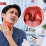 Ilustrasi abses peritonsil berupa kantong nanah pada jaringan di sekitar amandel